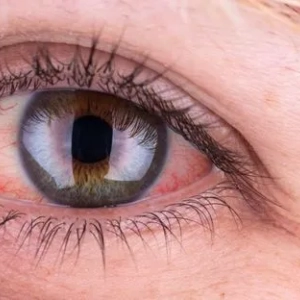 Příčina červených očí u dospělých a léčba. Poranění a oční onemocnění
